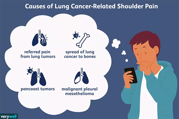 درد شانه علت سرطان ریه یک